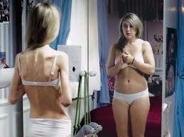 bulimia-anoreksja